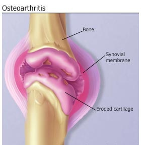 osteoarthritis(آرتروز)