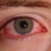 بیماری چشم صورتی یا التهاب ملتحمه ی چشم